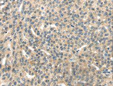 RASA2 Antibody - Immunohistochemistry of paraffin-embedded Human ovarian cancer using RASA2 Polyclonal Antibody at dilution of 1:45.