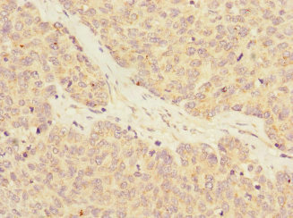 RASA4 / CAPRI Antibody - Immunohistochemistry of paraffin-embedded human ovarian cancer at dilution 1:100
