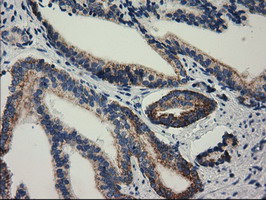 RASD2 Antibody - IHC of paraffin-embedded Carcinoma of Human prostate tissue using anti-RASD2 mouse monoclonal antibody. (Heat-induced epitope retrieval by 10mM citric buffer, pH6.0, 100C for 10min).