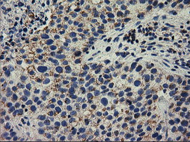RASD2 Antibody - IHC of paraffin-embedded Carcinoma of Human bladder tissue using anti-RASD2 mouse monoclonal antibody. (Heat-induced epitope retrieval by 10mM citric buffer, pH6.0, 100C for 10min).