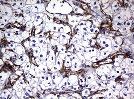 RASGRP3 / GRP3 Antibody - IHC of paraffin-embedded Carcinoma of Human kidney tissue using anti-RASGRP3 mouse monoclonal antibody. (Heat-induced epitope retrieval by 10mM citric buffer, pH6.0, 120°C for 3min).