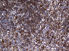 RASGRP3 / GRP3 Antibody - IHC of paraffin-embedded Human lymphoma tissue using anti-RASGRP3 mouse monoclonal antibody. (Heat-induced epitope retrieval by 10mM citric buffer, pH6.0, 120°C for 3min).
