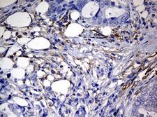 RASGRP3 / GRP3 Antibody - IHC of paraffin-embedded Adenocarcinoma of Human breast tissue using anti-RASGRP3 mouse monoclonal antibody. (Heat-induced epitope retrieval by 10mM citric buffer, pH6.0, 120°C for 3min).