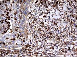 RASGRP3 / GRP3 Antibody - IHC of paraffin-embedded Carcinoma of Human lung tissue using anti-RASGRP3 mouse monoclonal antibody. (Heat-induced epitope retrieval by 10mM citric buffer, pH6.0, 120°C for 3min).