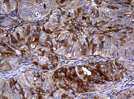 RASGRP3 / GRP3 Antibody - IHC of paraffin-embedded Adenocarcinoma of Human ovary tissue using anti-RASGRP3 mouse monoclonal antibody. (Heat-induced epitope retrieval by 10mM citric buffer, pH6.0, 120°C for 3min).