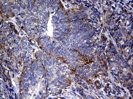 RASGRP3 / GRP3 Antibody - IHC of paraffin-embedded Adenocarcinoma of Human endometrium tissue using anti-RASGRP3 mouse monoclonal antibody. (Heat-induced epitope retrieval by 10mM citric buffer, pH6.0, 120°C for 3min).