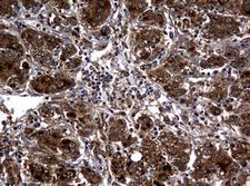 RASGRP3 / GRP3 Antibody - IHC of paraffin-embedded Carcinoma of Human liver tissue using anti-RASGRP3 mouse monoclonal antibody. (Heat-induced epitope retrieval by 10mM citric buffer, pH6.0, 120°C for 3min).