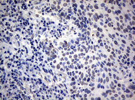 RASGRP3 / GRP3 Antibody - IHC of paraffin-embedded Carcinoma of Human lung tissue using anti-RASGRP3 mouse monoclonal antibody.