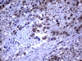 RASGRP3 / GRP3 Antibody - IHC of paraffin-embedded Adenocarcinoma of Human ovary tissue using anti-RASGRP3 mouse monoclonal antibody.