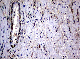 RASGRP3 / GRP3 Antibody - IHC of paraffin-embedded Carcinoma of Human prostate tissue using anti-RASGRP3 mouse monoclonal antibody.