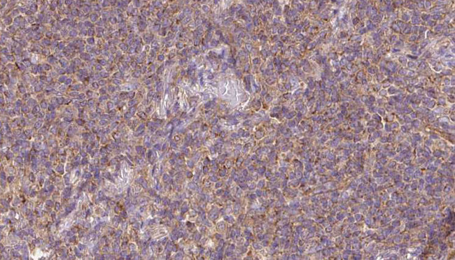 RASGRP3 / GRP3 Antibody - 1:100 staining human lymph carcinoma tissue by IHC-P. The sample was formaldehyde fixed and a heat mediated antigen retrieval step in citrate buffer was performed. The sample was then blocked and incubated with the antibody for 1.5 hours at 22°C. An HRP conjugated goat anti-rabbit antibody was used as the secondary.