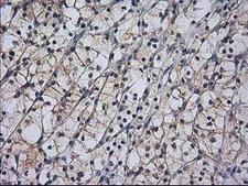 RASSF1 / RASSF1A Antibody - IHC of paraffin-embedded Carcinoma of Human kidney tissue using anti-RASSF1 mouse monoclonal antibody. (Heat-induced epitope retrieval by 10mM citric buffer, pH6.0, 100C for 10min).