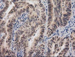 RASSF1 / RASSF1A Antibody - IHC of paraffin-embedded Carcinoma of Human lung tissue using anti-RASSF1 mouse monoclonal antibody. (Heat-induced epitope retrieval by 10mM citric buffer, pH6.0, 100C for 10min).