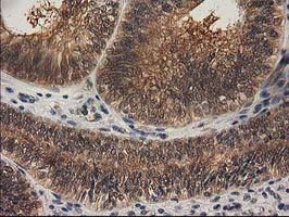 RASSF1 / RASSF1A Antibody - IHC of paraffin-embedded Adenocarcinoma of Human endometrium tissue using anti-RASSF1 mouse monoclonal antibody. (Heat-induced epitope retrieval by 10mM citric buffer, pH6.0, 100C for 10min).