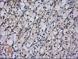 RASSF1 / RASSF1A Antibody - IHC of paraffin-embedded Carcinoma of Human kidney tissue using anti-RASSF1 mouse monoclonal antibody. (Heat-induced epitope retrieval by 10mM citric buffer, pH6.0, 100C for 10min).