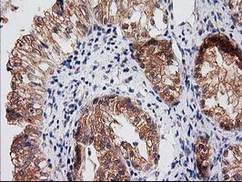 RASSF1 / RASSF1A Antibody - IHC of paraffin-embedded Adenocarcinoma of Human ovary tissue using anti-RASSF1 mouse monoclonal antibody. (Heat-induced epitope retrieval by 10mM citric buffer, pH6.0, 100C for 10min).