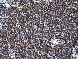 RASSF1 / RASSF1A Antibody - IHC of paraffin-embedded Carcinoma of Human thyroid tissue using anti-RASSF1 mouse monoclonal antibody. (Heat-induced epitope retrieval by 10mM citric buffer, pH6.0, 100C for 10min).