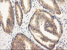 RASSF1 / RASSF1A Antibody - IHC of paraffin-embedded Carcinoma of Human prostate tissue using anti-RASSF1 mouse monoclonal antibody. (Heat-induced epitope retrieval by 10mM citric buffer, pH6.0, 100C for 10min).