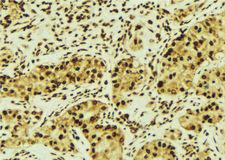 RASSF1 / RASSF1A Antibody - 1:100 staining human breast carcinoma tissue by IHC-P. The sample was formaldehyde fixed and a heat mediated antigen retrieval step in citrate buffer was performed. The sample was then blocked and incubated with the antibody for 1.5 hours at 22°C. An HRP conjugated goat anti-rabbit antibody was used as the secondary.