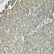 RASSF1 / RASSF1A Antibody - Immunohistochemistry of paraffin-embedded Human liver cancer using RASSF1 Polyclonal Antibody at dilution of 1:100 (40x lens).