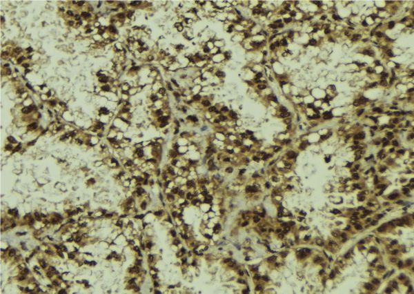 RASSF2 Antibody - 1:100 staining human lung tissue by IHC-P. The sample was formaldehyde fixed and a heat mediated antigen retrieval step in citrate buffer was performed. The sample was then blocked and incubated with the antibody for 1.5 hours at 22°C. An HRP conjugated goat anti-rabbit antibody was used as the secondary.