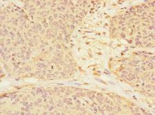 RASSF6 Antibody - Immunohistochemistry of paraffin-embedded human ovarian cancer at dilution 1:100