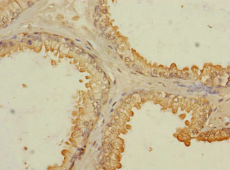 RASSF6 Antibody - Immunohistochemistry of paraffin-embedded human prostata cancer cancer at dilution 1:100