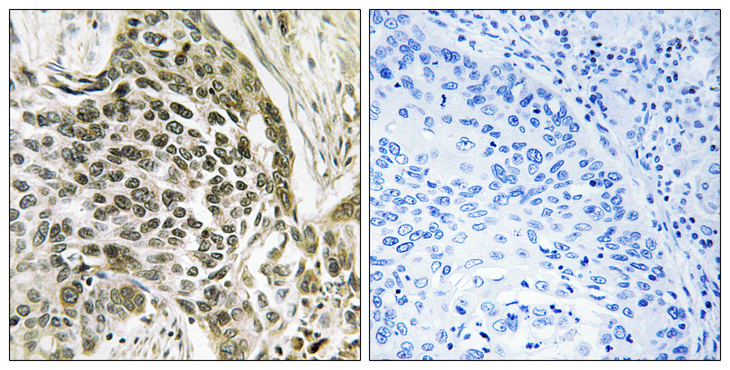 RASSF7 Antibody - Immunohistochemistry analysis of paraffin-embedded human lung carcinoma tissue, using RASSF7 Antibody. The picture on the right is blocked with the synthesized peptide.