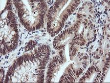 RASSF8 Antibody - IHC of paraffin-embedded Adenocarcinoma of Human colon tissue using anti-RASSF8 mouse monoclonal antibody.