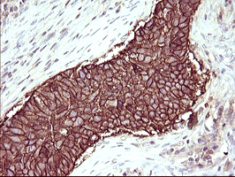 RASSF8 Antibody - IHC of paraffin-embedded Carcinoma of Human lung tissue using anti-RASSF8 mouse monoclonal antibody. (Heat-induced epitope retrieval by 10mM citric buffer, pH6.0, 120°C for 3min).