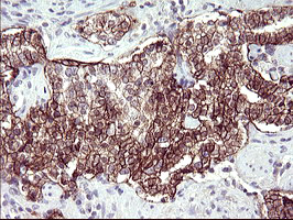 RASSF8 Antibody - IHC of paraffin-embedded Carcinoma of Human prostate tissue using anti-RASSF8 mouse monoclonal antibody. (Heat-induced epitope retrieval by 10mM citric buffer, pH6.0, 120°C for 3min).
