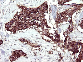 RASSF8 Antibody - IHC of paraffin-embedded Carcinoma of Human bladder tissue using anti-RASSF8 mouse monoclonal antibody. (Heat-induced epitope retrieval by 10mM citric buffer, pH6.0, 120°C for 3min).
