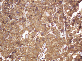RASSF8 Antibody - IHC of paraffin-embedded Adenocarcinoma of Human colon tissue using anti-RASSF8 mouse monoclonal antibody.
