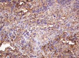 RASSF8 Antibody - IHC of paraffin-embedded Carcinoma of Human lung tissue using anti-RASSF8 mouse monoclonal antibody.