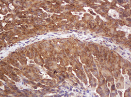 RASSF8 Antibody - IHC of paraffin-embedded Adenocarcinoma of Human ovary tissue using anti-RASSF8 mouse monoclonal antibody.
