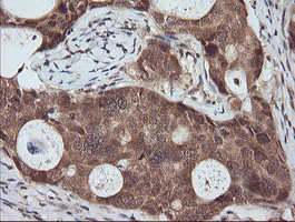 RASSF8 Antibody - IHC of paraffin-embedded Adenocarcinoma of Human breast tissue using anti-RASSF8 mouse monoclonal antibody.