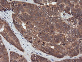 RASSF8 Antibody - IHC of paraffin-embedded Adenocarcinoma of Human ovary tissue using anti-RASSF8 mouse monoclonal antibody.