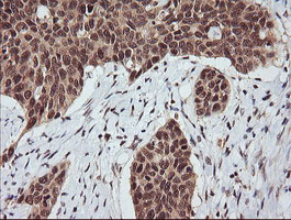 RASSF8 Antibody - IHC of paraffin-embedded Carcinoma of Human bladder tissue using anti-RASSF8 mouse monoclonal antibody.