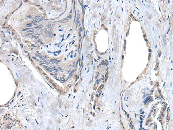 RASSF8 Antibody - Immunohistochemistry of paraffin-embedded Human thyroid cancer tissue  using RASSF8 Polyclonal Antibody at dilution of 1:55(×200)