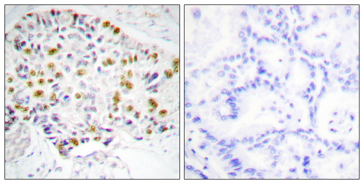 RB1 / Retinoblastoma / RB Antibody - Immunohistochemistry analysis of paraffin-embedded human lung carcinoma tissue, using Retinoblastoma Antibody. The picture on the right is blocked with the synthesized peptide.