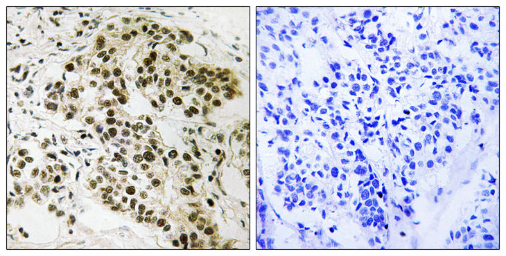 RB1 / Retinoblastoma / RB Antibody - Immunohistochemistry analysis of paraffin-embedded human breast carcinoma tissue, using Retinoblastoma Antibody. The picture on the right is blocked with the synthesized peptide.