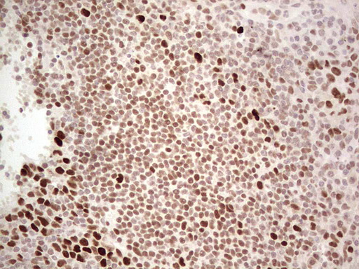 RB1 / Retinoblastoma / RB Antibody - Immunohistochemical staining of paraffin-embedded Human tonsil within the normal limits using anti-RB1 mouse monoclonal antibody. (Heat-induced epitope retrieval by 1 mM EDTA in 10mM Tris, pH8.5, 120C for 3min,