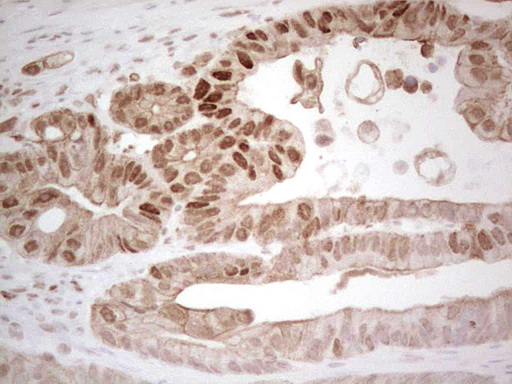 RB1 / Retinoblastoma / RB Antibody - IHC of paraffin-embedded Adenocarcinoma of Human colon tissue using anti-RB1 mouse monoclonal antibody. (Heat-induced epitope retrieval by 1 mM EDTA in 10mM Tris, pH8.5, 120°C for 3min).