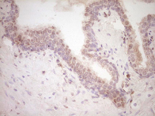 RB1 / Retinoblastoma / RB Antibody - IHC of paraffin-embedded Carcinoma of Human prostate tissue using anti-RB1 mouse monoclonal antibody. (Heat-induced epitope retrieval by 1 mM EDTA in 10mM Tris, pH8.5, 120°C for 3min).
