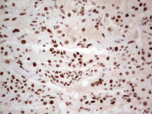 RB1 / Retinoblastoma / RB Antibody - Immunohistochemical staining of paraffin-embedded Carcinoma of Human lung tissue using anti-RB1 mouse monoclonal antibody. (Heat-induced epitope retrieval by 1 mM EDTA in 10mM Tris, pH8.5, 120C for 3min,