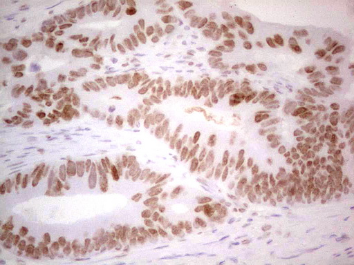 RB1 / Retinoblastoma / RB Antibody - Immunohistochemical staining of paraffin-embedded Adenocarcinoma of Human colon tissue using anti-RB1 mouse monoclonal antibody. (Heat-induced epitope retrieval by 1 mM EDTA in 10mM Tris, pH8.5, 120C for 3min,