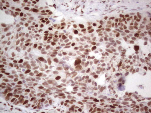 RB1 / Retinoblastoma / RB Antibody - Immunohistochemical staining of paraffin-embedded Carcinoma of Human kidney tissue using anti-RB1 mouse monoclonal antibody. (Heat-induced epitope retrieval by 1 mM EDTA in 10mM Tris, pH8.5, 120C for 3min,