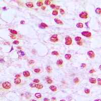 RB1 / Retinoblastoma / RB Antibody - Immunohistochemical analysis of RB1 staining in human breast cancer formalin fixed paraffin embedded tissue section. The section was pre-treated using heat mediated antigen retrieval with sodium citrate buffer (pH 6.0). The section was then incubated with the antibody at room temperature and detected using an HRP conjugated compact polymer system. DAB was used as the chromogen. The section was then counterstained with hematoxylin and mounted with DPX.