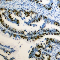 RB1 / Retinoblastoma / RB Antibody - Immunohistochemical analysis of RB1 (pS795) staining in human colon cancer formalin fixed paraffin embedded tissue section. The section was pre-treated using heat mediated antigen retrieval with sodium citrate buffer (pH 6.0). The section was then incubated with the antibody at room temperature and detected using an HRP polymer system. DAB was used as the chromogen. The section was then counterstained with hematoxylin and mounted with DPX.