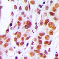 RB1 / Retinoblastoma / RB Antibody - Immunohistochemical analysis of RB1 staining in human stomach cancer formalin fixed paraffin embedded tissue section. The section was pre-treated using heat mediated antigen retrieval with sodium citrate buffer (pH 6.0). The section was then incubated with the antibody at room temperature and detected using an HRP polymer system. DAB was used as the chromogen. The section was then counterstained with hematoxylin and mounted with DPX.